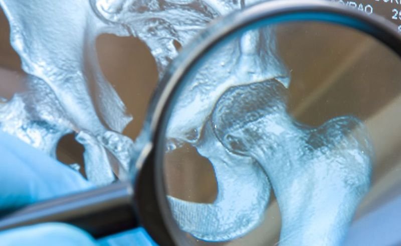 Osteoartrosis de cadera